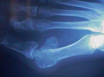 X-ray of Bunion Deformity